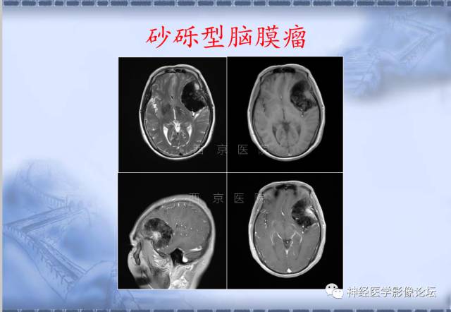 【病例】脑内常见病例的罕见影像表现——肉芽肿性炎1例MR