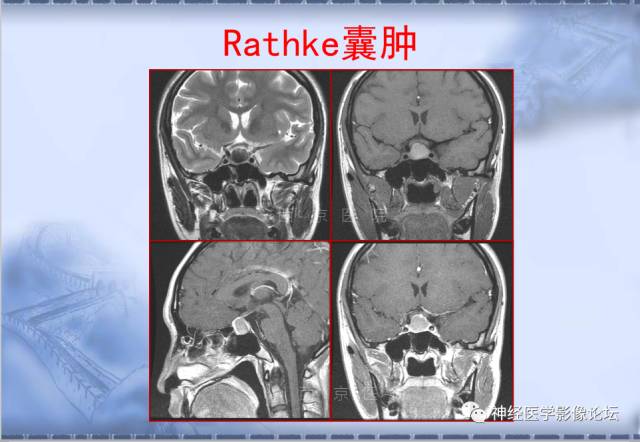 【病例】脑内常见病例的罕见影像表现——肉芽肿性炎1例MR