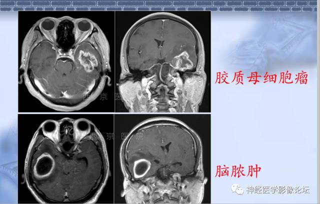 【病例】脑内常见病例的罕见影像表现——肉芽肿性炎1例MR