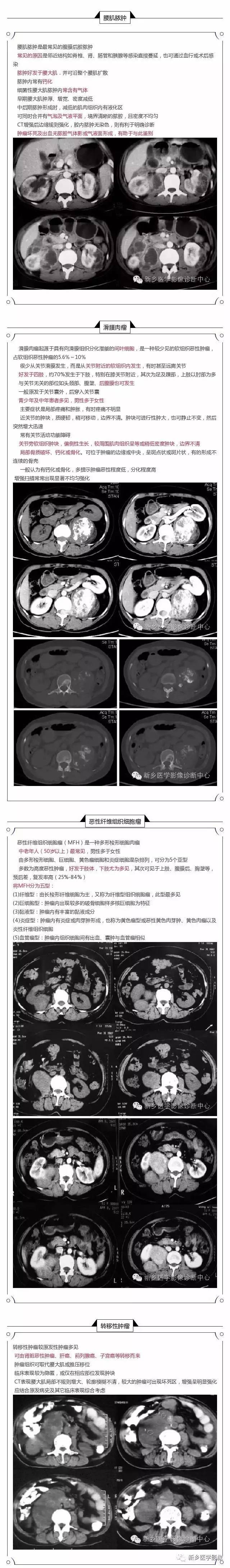 腰大肌病变，应想这四种疾病