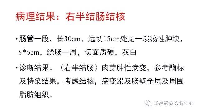 【病例】结肠结核1例CT影像表现