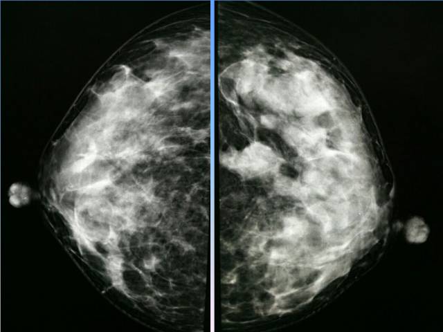 【病例】乳腺粘液腺癌1例X线钼靶影像表现