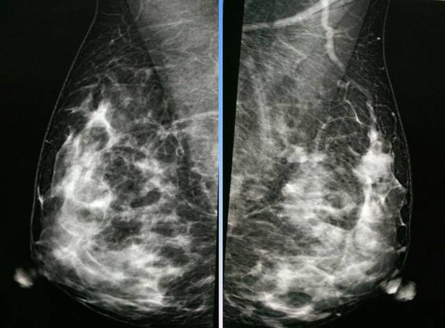 【病例】乳腺粘液腺癌1例X线钼靶影像表现