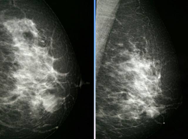 【病例】乳腺粘液腺癌1例X线钼靶影像表现