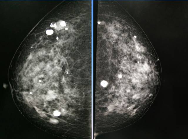 【病例】乳腺粘液腺癌1例X线钼靶影像表现