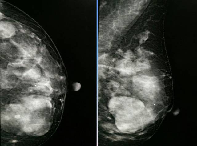 【病例】乳腺粘液腺癌1例X线钼靶影像表现