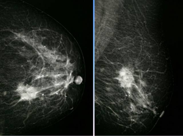 【病例】乳腺粘液腺癌1例X线钼靶影像表现