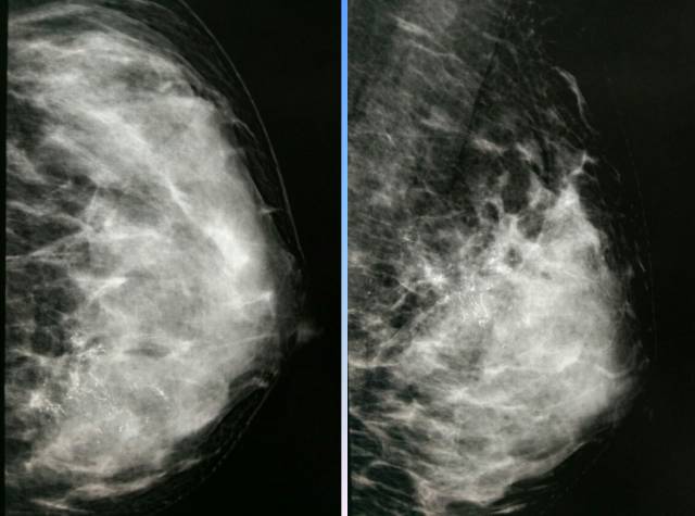 【病例】乳腺粘液腺癌1例X线钼靶影像表现