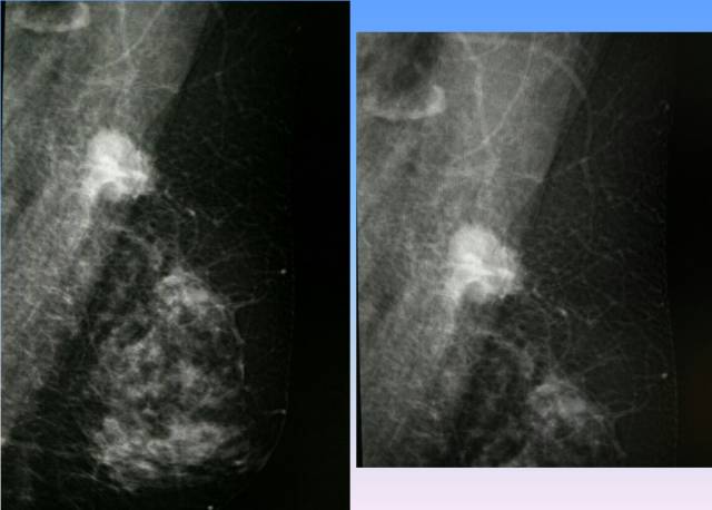 【病例】乳腺粘液腺癌1例X线钼靶影像表现