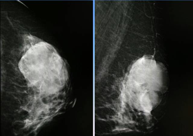 【病例】乳腺粘液腺癌1例X线钼靶影像表现