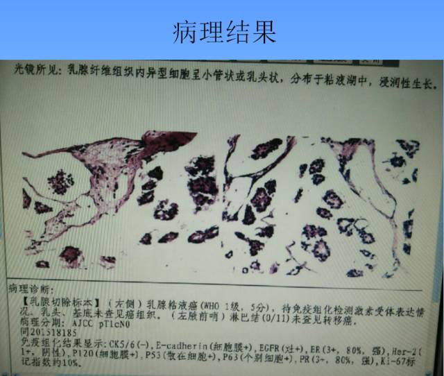 【病例】乳腺粘液腺癌1例X线钼靶影像表现