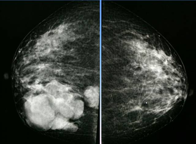 【病例】乳腺粘液腺癌1例X线钼靶影像表现