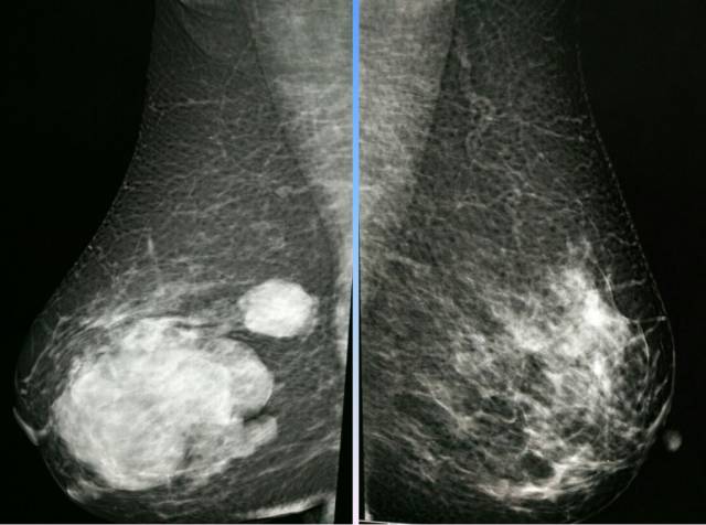【病例】乳腺粘液腺癌1例X线钼靶影像表现