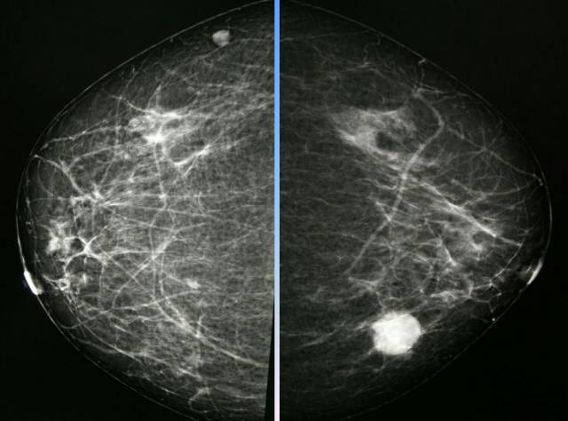 【病例】乳腺粘液腺癌1例X线钼靶影像表现