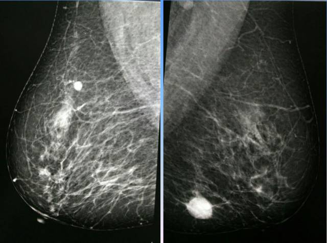 【病例】乳腺粘液腺癌1例X线钼靶影像表现