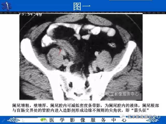 【影像征象】箭头征