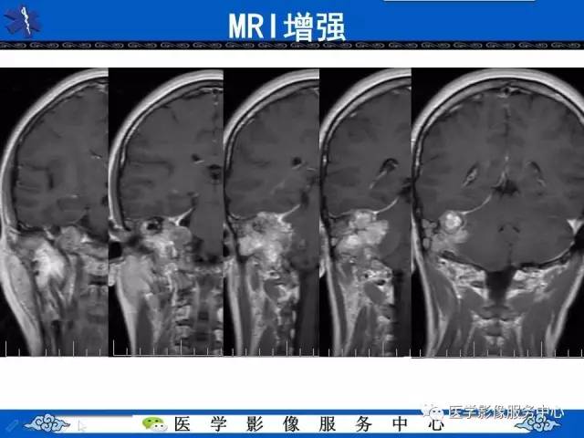 【病例】内淋巴囊乳头状瘤1例MR