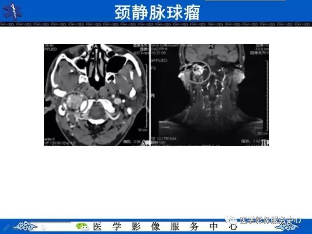 【病例】内淋巴囊乳头状瘤1例MR