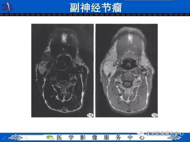 【病例】内淋巴囊乳头状瘤1例MR