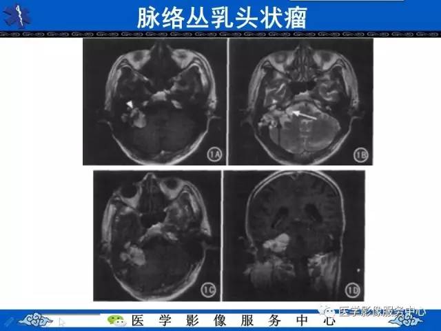 【病例】内淋巴囊乳头状瘤1例MR