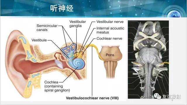 【PPT】桥小脑角区肿瘤——听神经瘤