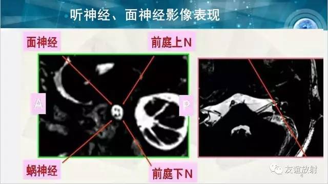 【PPT】桥小脑角区肿瘤——听神经瘤