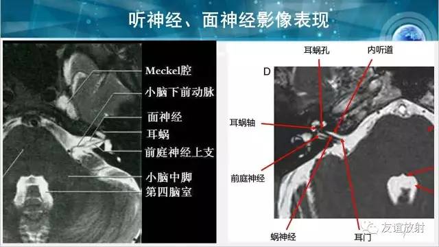 【PPT】桥小脑角区肿瘤——听神经瘤