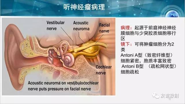 【PPT】桥小脑角区肿瘤——听神经瘤