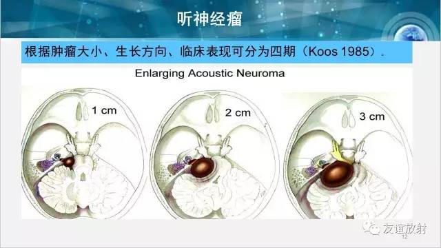 【PPT】桥小脑角区肿瘤——听神经瘤