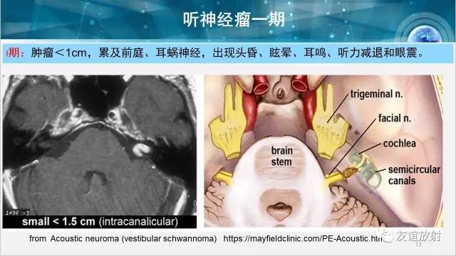 【PPT】桥小脑角区肿瘤——听神经瘤