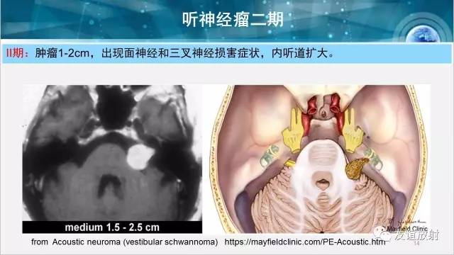 【PPT】桥小脑角区肿瘤——听神经瘤
