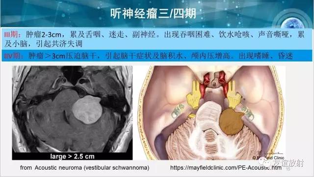 【PPT】桥小脑角区肿瘤——听神经瘤