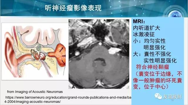 【PPT】桥小脑角区肿瘤——听神经瘤