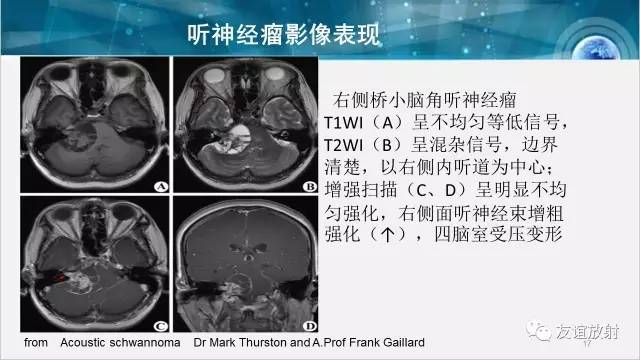 【PPT】桥小脑角区肿瘤——听神经瘤