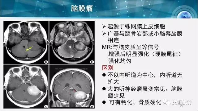 【PPT】桥小脑角区肿瘤——听神经瘤