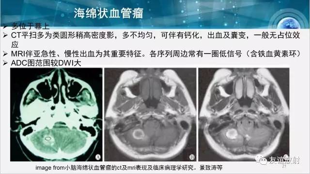 【PPT】桥小脑角区肿瘤——听神经瘤