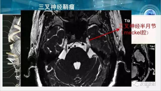 【PPT】桥小脑角区肿瘤——听神经瘤