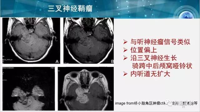 【PPT】桥小脑角区肿瘤——听神经瘤