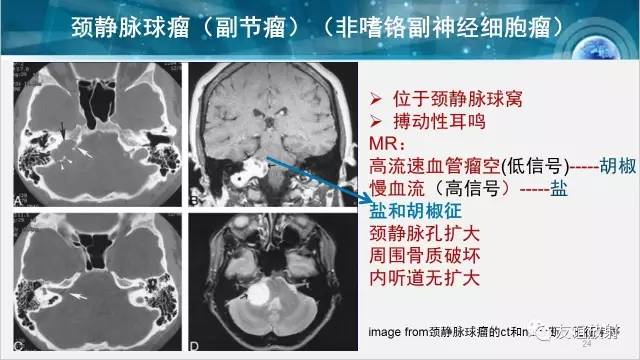 【PPT】桥小脑角区肿瘤——听神经瘤