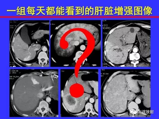 肝实质异常灌注CT、MRI评价