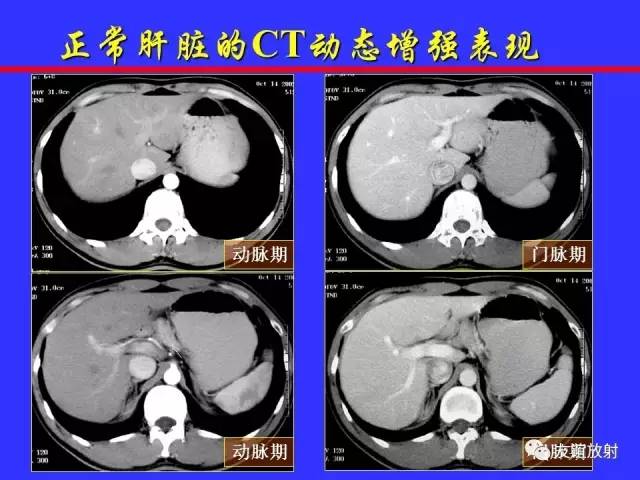 肝实质异常灌注CT、MRI评价