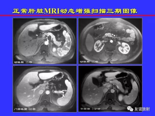 肝实质异常灌注CT、MRI评价