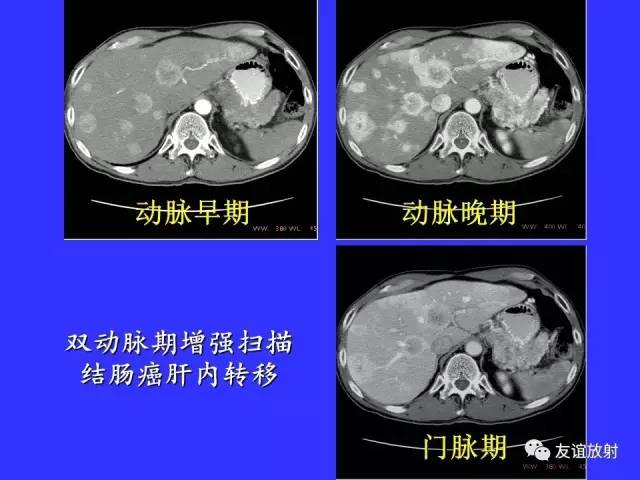肝实质异常灌注CT、MRI评价