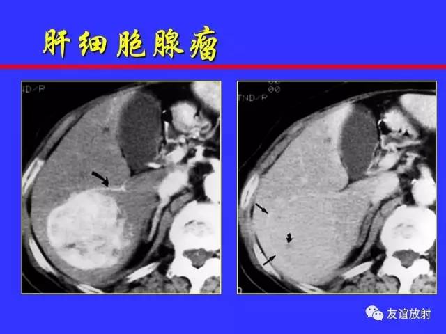 肝实质异常灌注CT、MRI评价