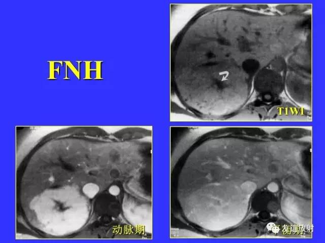 肝实质异常灌注CT、MRI评价