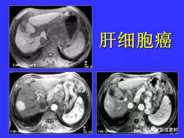 肝实质异常灌注CT、MRI评价