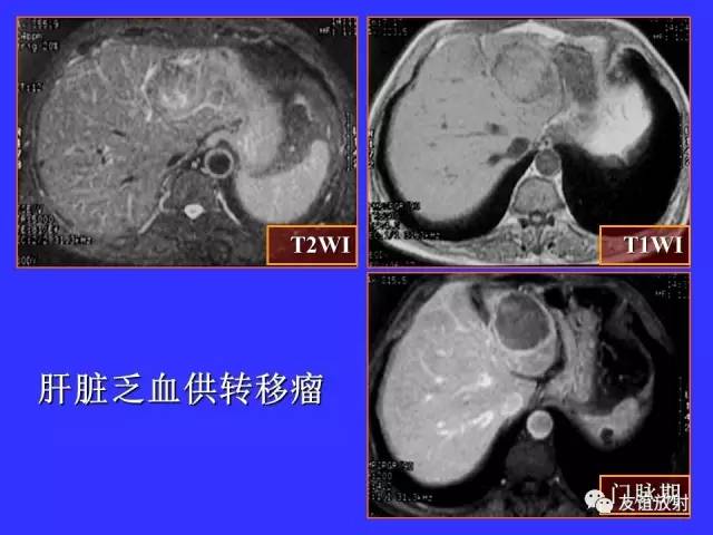 肝实质异常灌注CT、MRI评价
