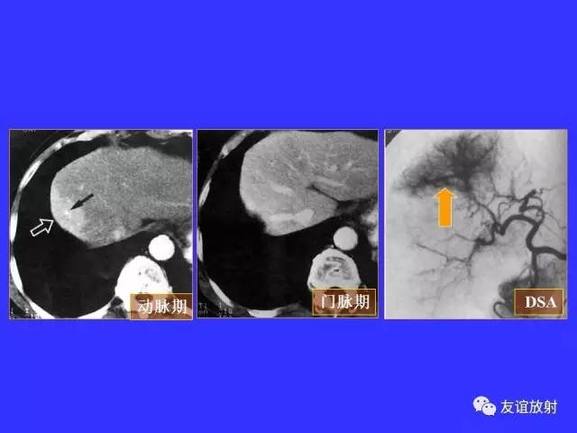 肝实质异常灌注CT、MRI评价