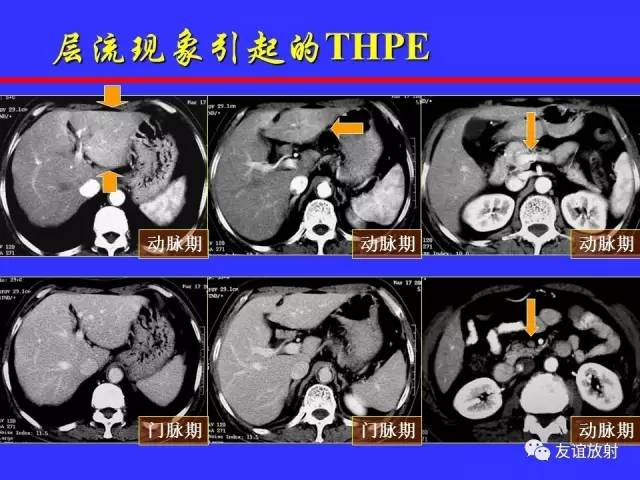 肝实质异常灌注CT、MRI评价