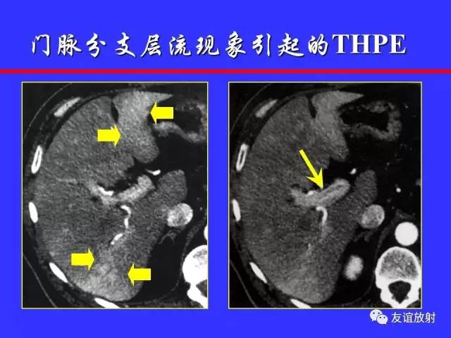 肝实质异常灌注CT、MRI评价